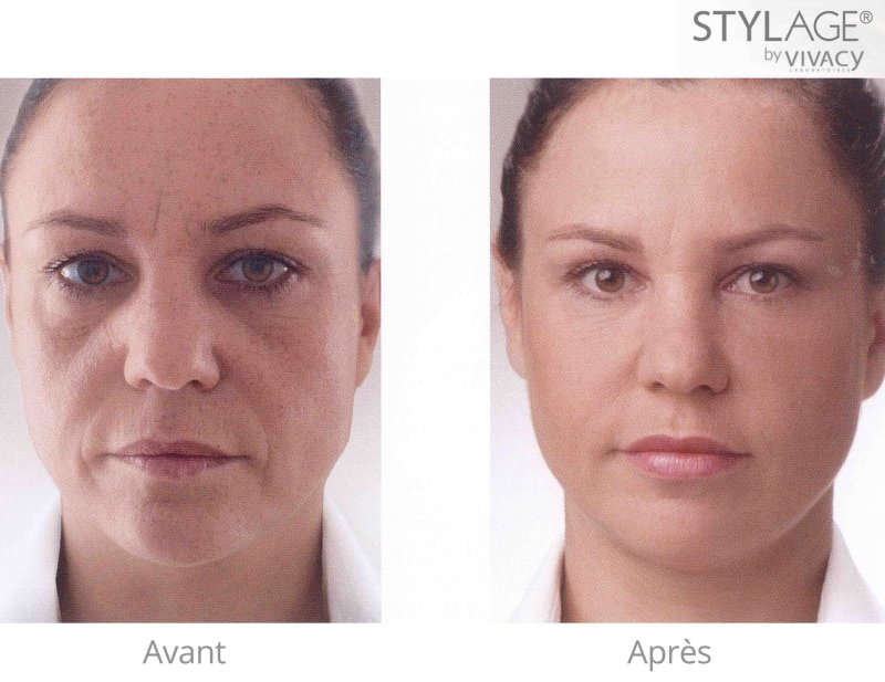 Stylage XL филлер до и после