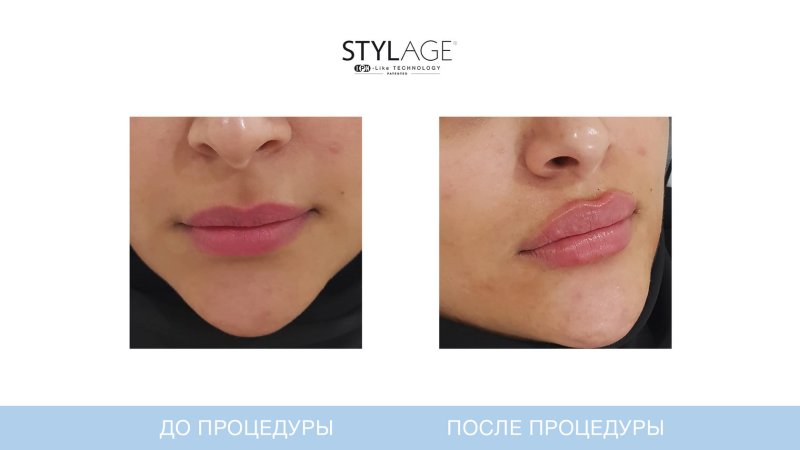 Препарат Stylage m в губы
