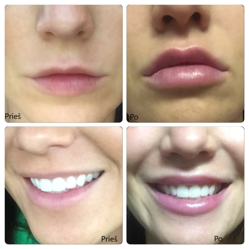 Juvederm Ultra XC.