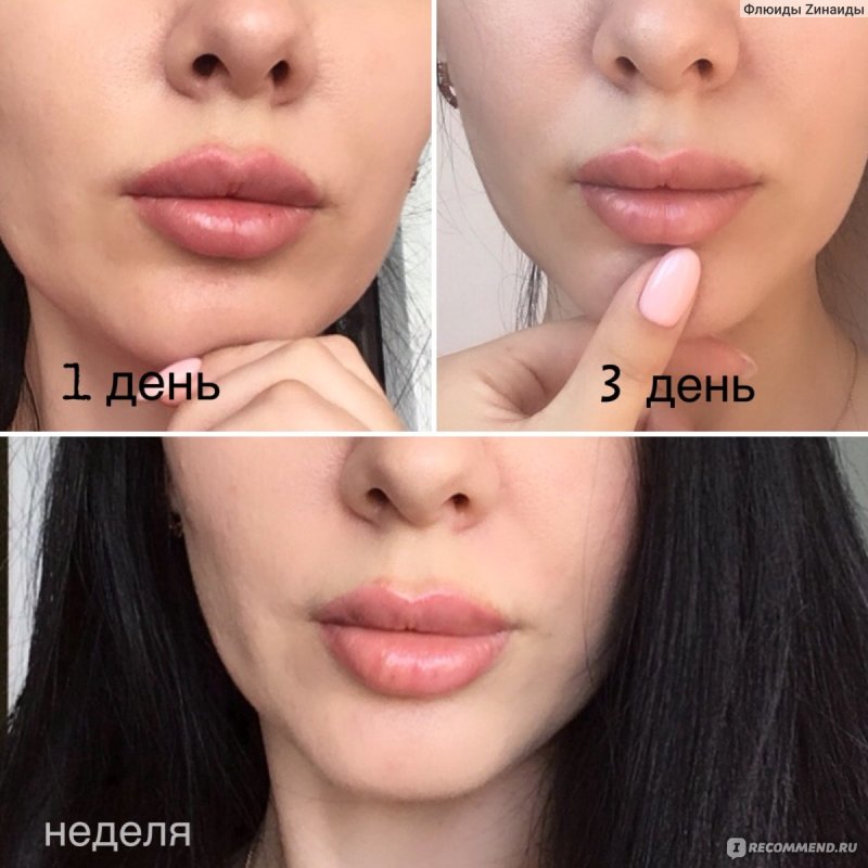 Губы бантиком увеличение гиалуроновой