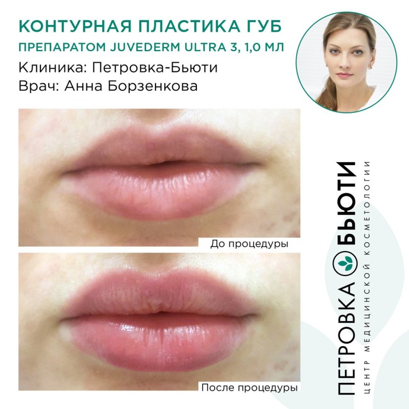 Схема контурной пластики губ