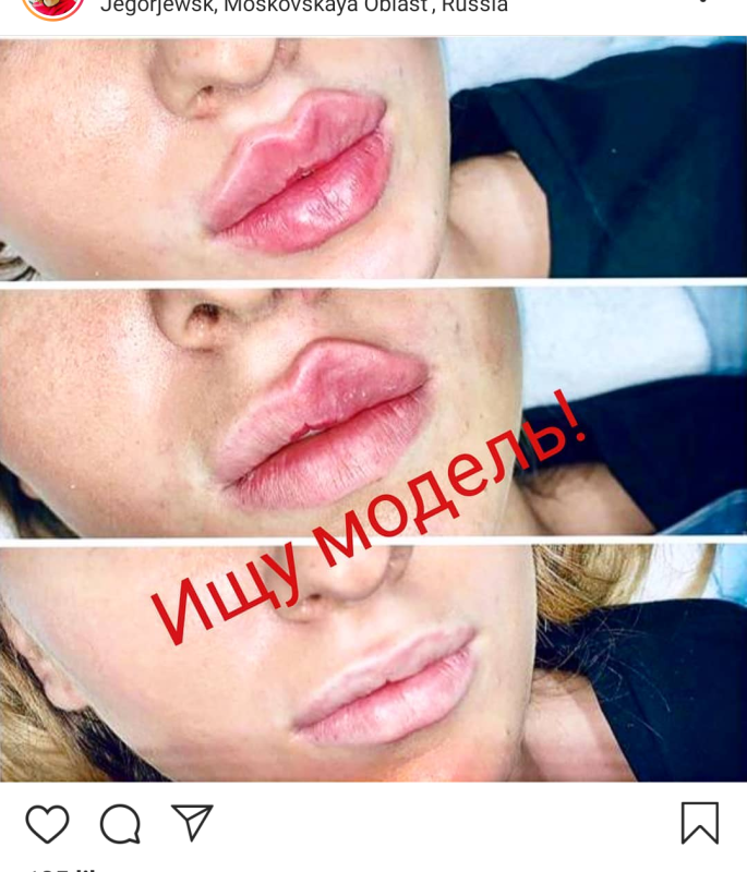 Техника ТП увеличение губ