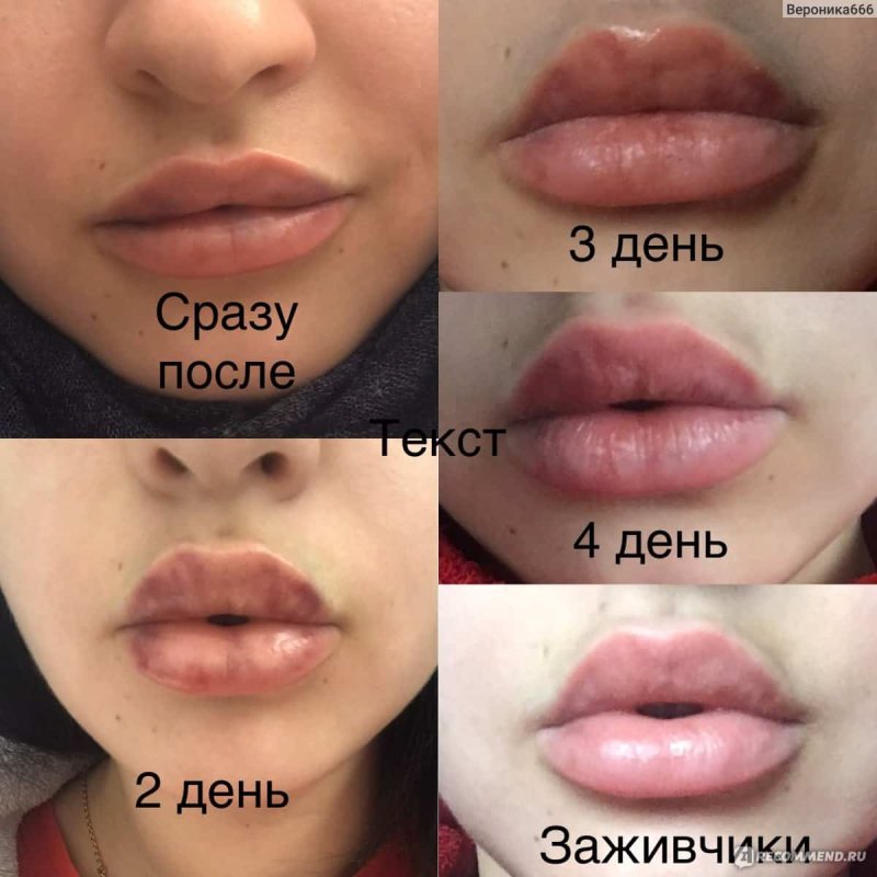 Препарат для увеличения губ Корея
