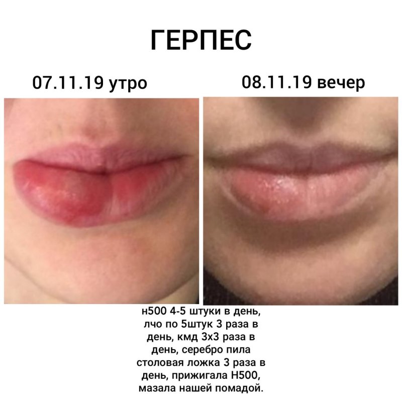 Этапы заживления герпеса