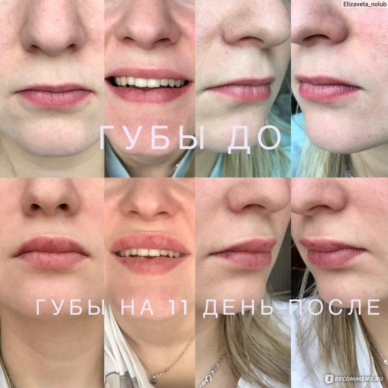 Препарат для увеличения губ реджинесс