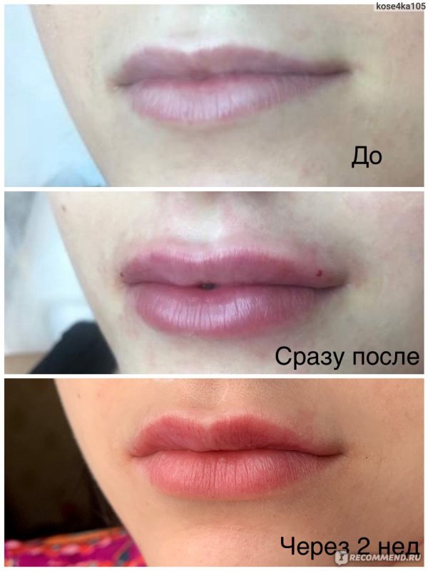 Губы после гиалуроновой кислоты 1 мл спустя месяц