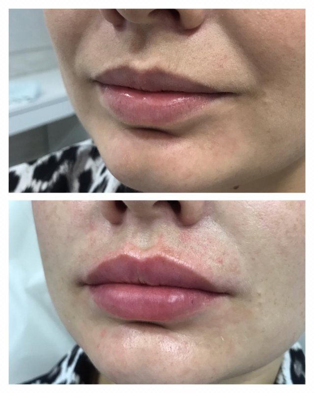 Stylage m для губ 1 мл до и после